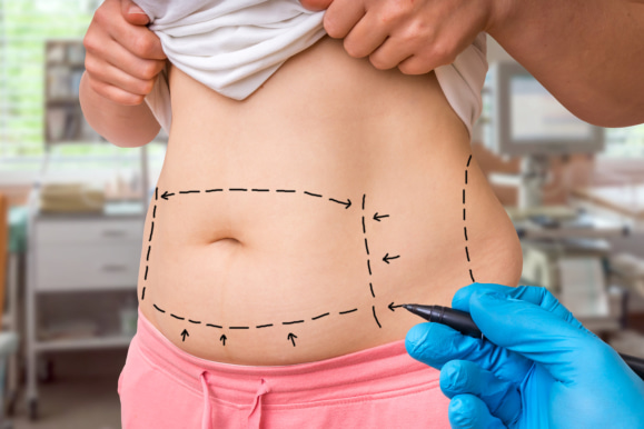 3 Questions to Ask Yourself Before Liposuction